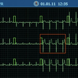 ecran_20ecg